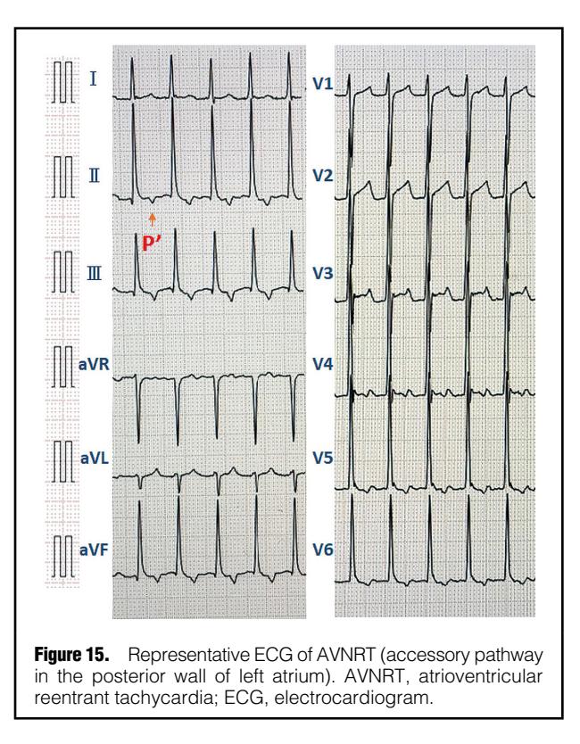 【JCS/JHRS 2022 Guideline】12-lead ECG demonstrating atrioventricular reentrant tachycardia