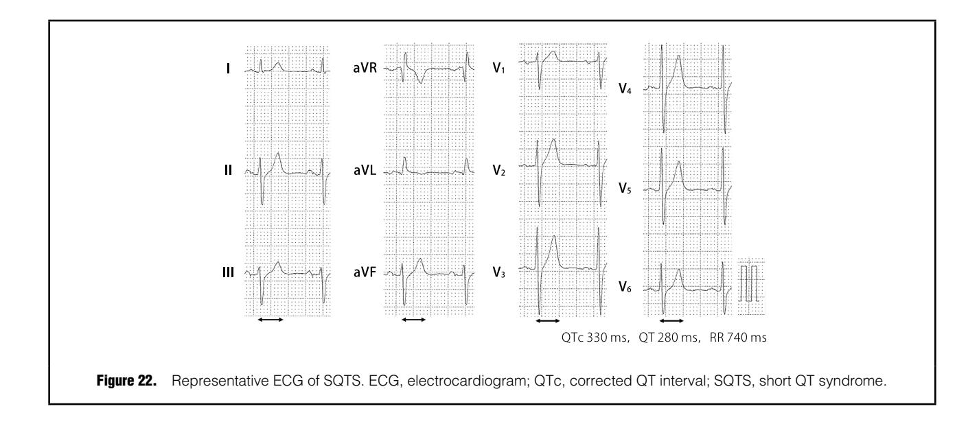【JCS/JHRS 2022 Guideline】12-lead ECG demonstrating Short QT Syndrome