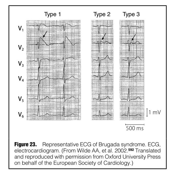 image_category: MEDICAL_IMAGING/Electrocardiogram (ECG) | body_region: chest | specialty: Cardiology | summary: ECG strip demonstrating the onset of Torsade de Pointes (TdP) following a period of prolonged QT interval.