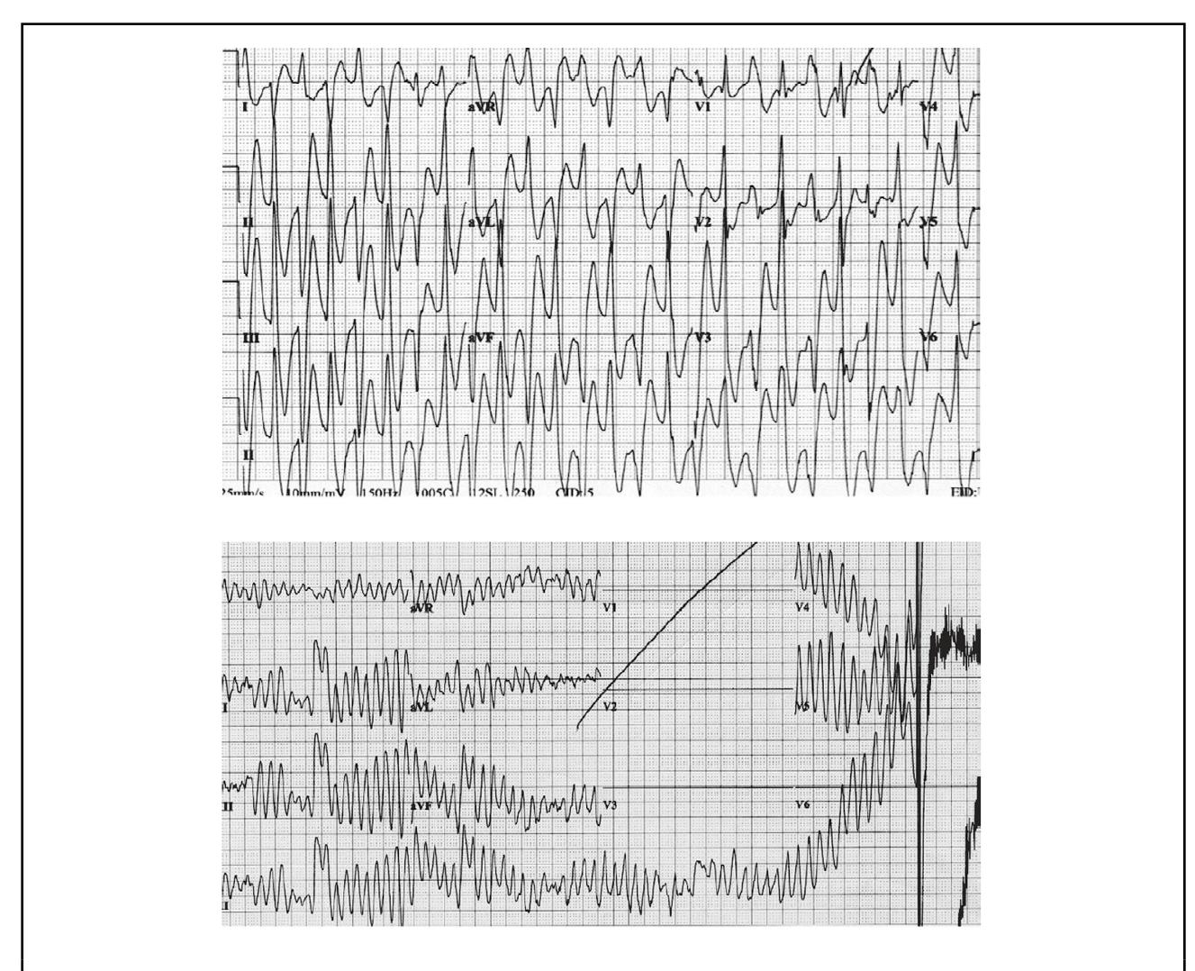 【JCS/JHRS 2022 Guideline】ECG progression from wide-complex tachycardia to ventricular fibrillation