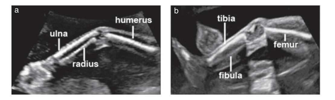 【Prenatal Ultrasound】Severe bowing and fractures of fetal long bones