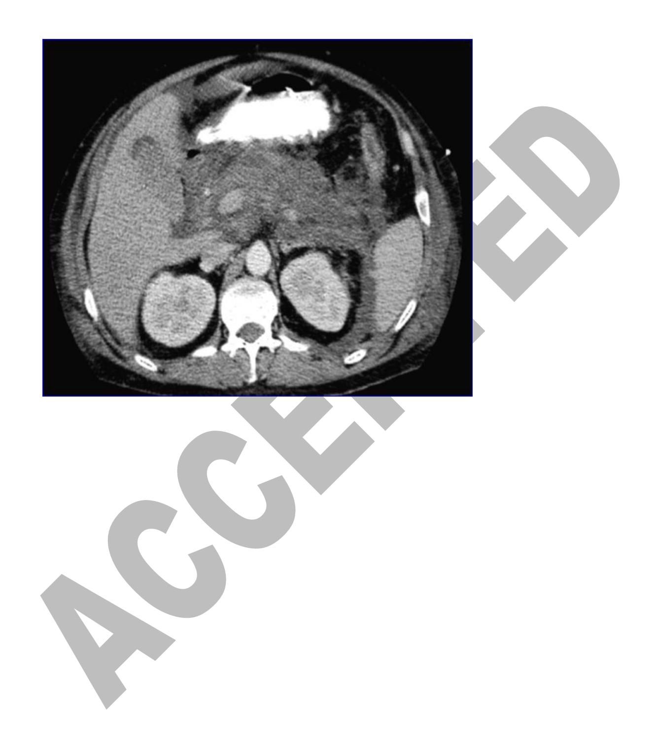 【Guidelines in Practice: Management of Acute Pancreatitis】CT scan