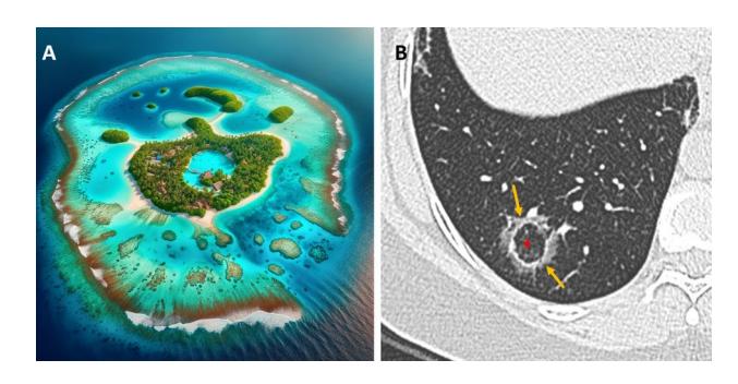 【Atlas of Diffuse Lung Diseases】Atoll Sign Comparison