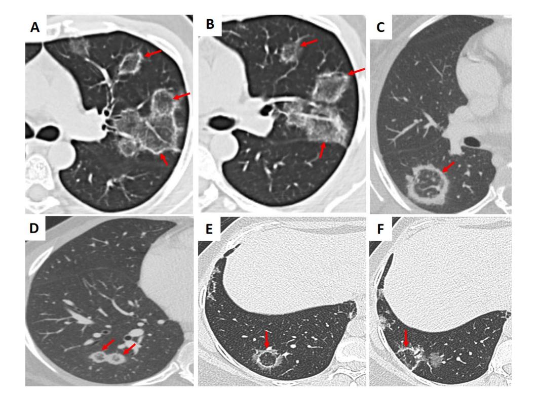 【Fleischner Society: Glossary of Terms for Thoracic Imaging】Organizing Pneumonia - Reversed Halo Sign