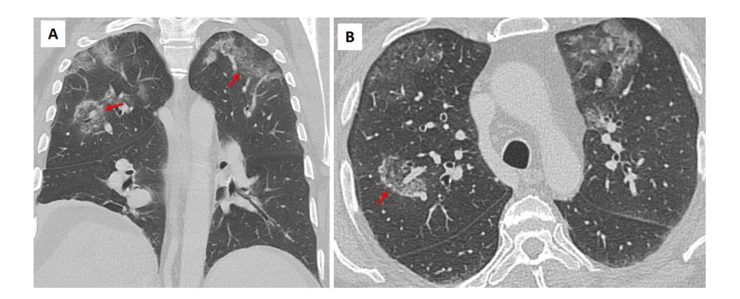 【Algorithmic Approach to the Diagnosis of Organizing Pneumonia】Reversed Halo Sign
