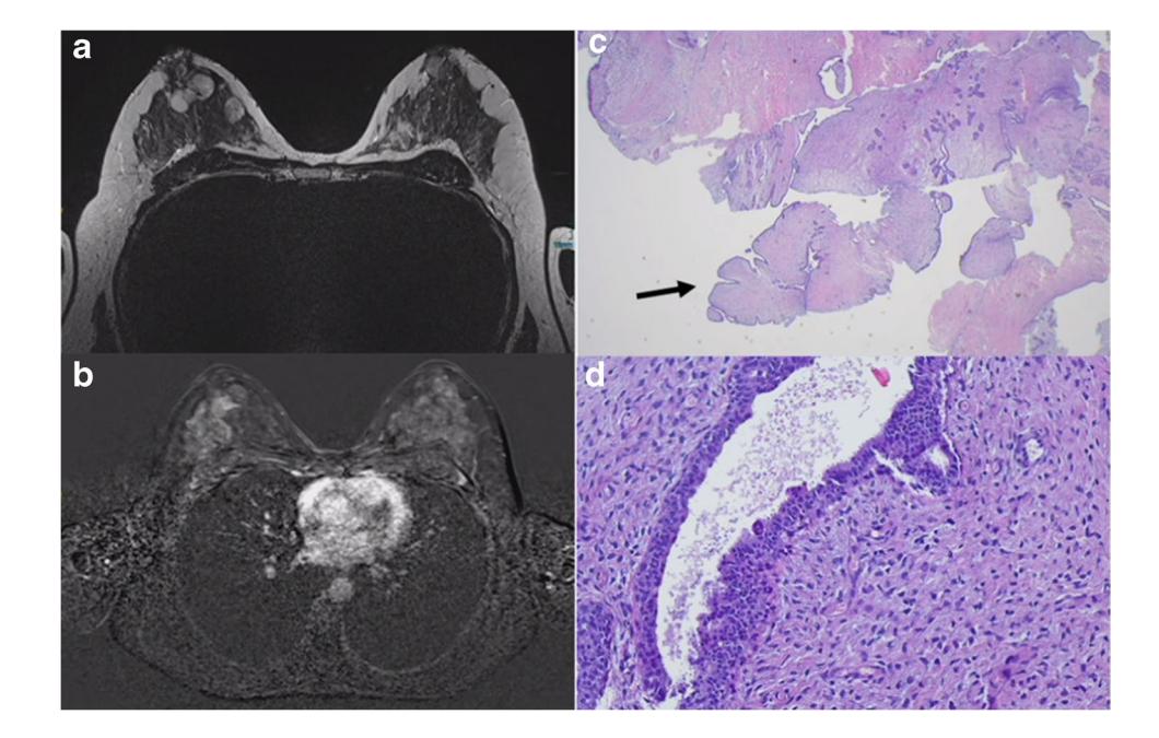 【Third International Consensus Conference on lesions of uncertain malignant potential in the breast (B3 lesions)】Breast MRI and H&E Histopathology