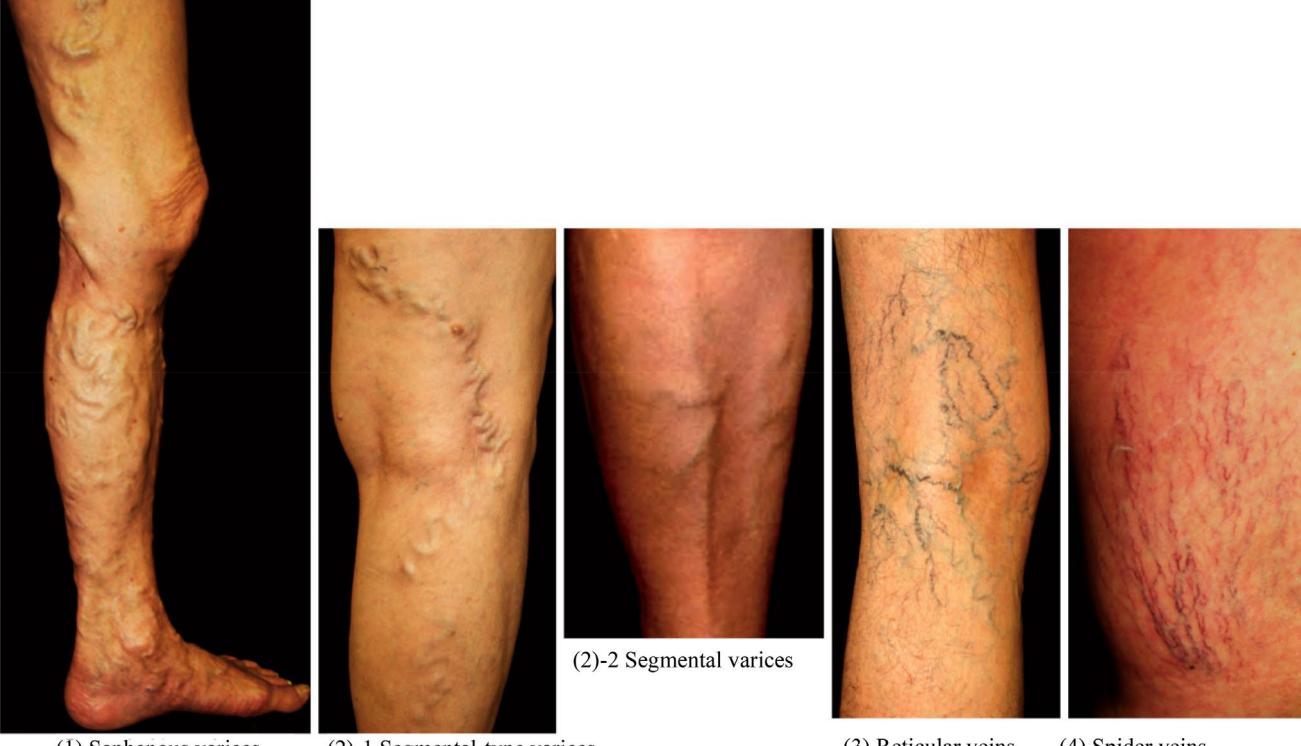 【Wound, Pressure Ulcer and Burn Guidelines (2023)-5: Guidelines for the Management of Lower Leg Ulcers/Varicose Veins, Third Edition Wound/Pressure Ulcer/Burn Guidelines Drafting Committee (Lower Leg Ulcers/Varicose Veins Group)】Dermatology/Vascular Surgery clinical photo