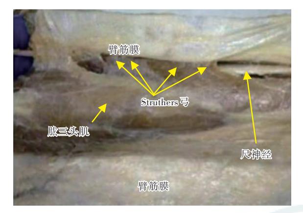 【尺神经阻滞疗法专家共识(2019版)】Struthers弓解剖