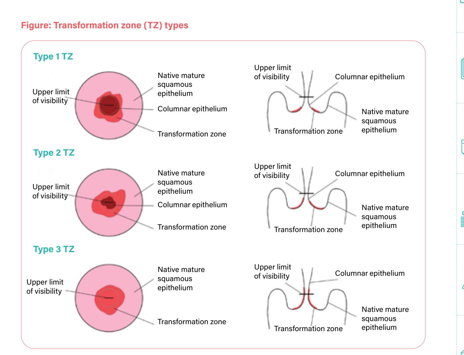 【Cervical Colposcopy Classification Diagram】Cervical Transformation Zone Types