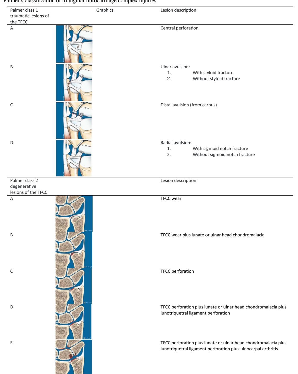 【Interdisciplinary consensus statements on imaging of DRUJ instability and TFCC injuries】Medical Illustration