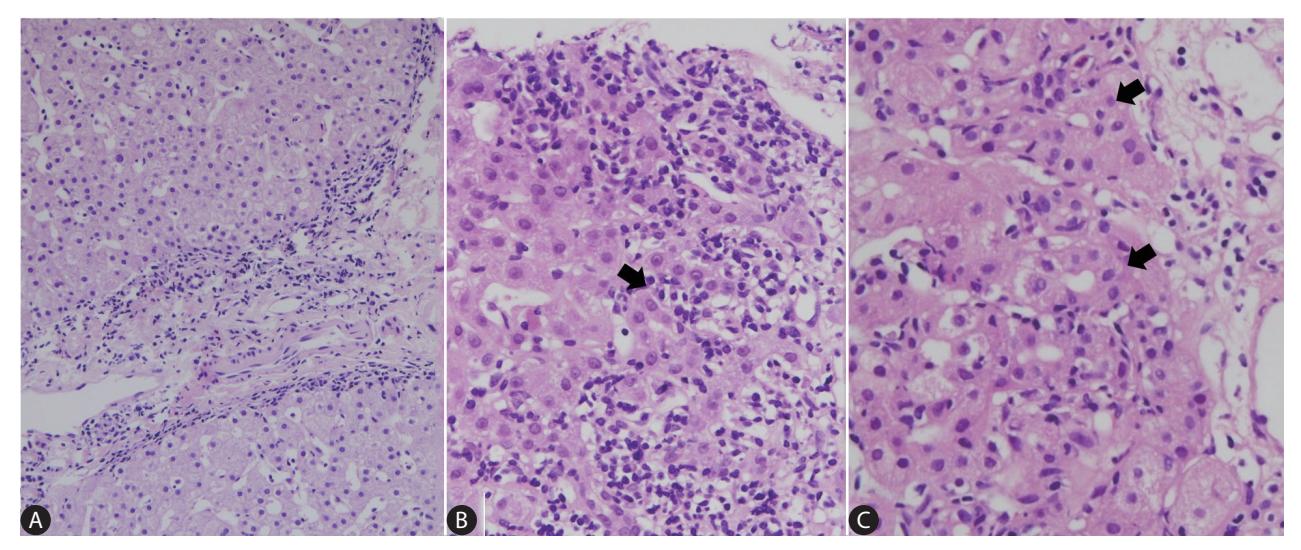 【KASL临床实践指南:自身免疫性肝炎的管理】Histopathology of autoimmune hepatitis