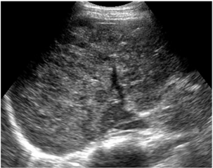 Cavernous hemangioma