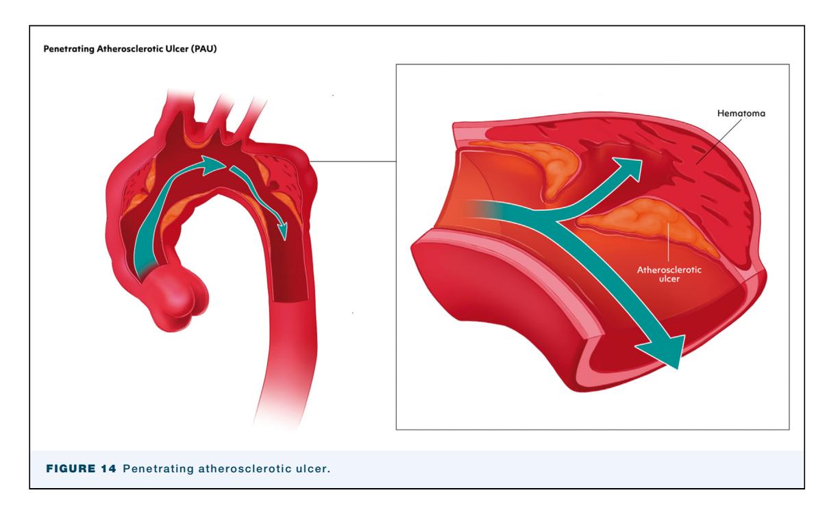 【EACTS/STS Guidelines】Penetrating Atherosclerotic Ulcer Illustration
