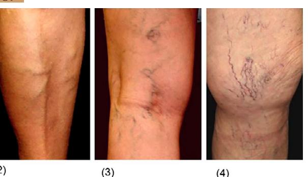 【Wound, Pressure Ulcer, and Burn Guidelines-5: Guidelines for the management of lower leg ulcers and varicose veins, second edition】Clinical photograph of lower limb venous disease