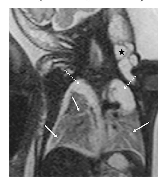 【Indications for magnetic resonance imaging of the fetal body (extra-central nervous system): recommendations from the European Society of Paediatric Radiology Fetal Task Force】Fetal MRI