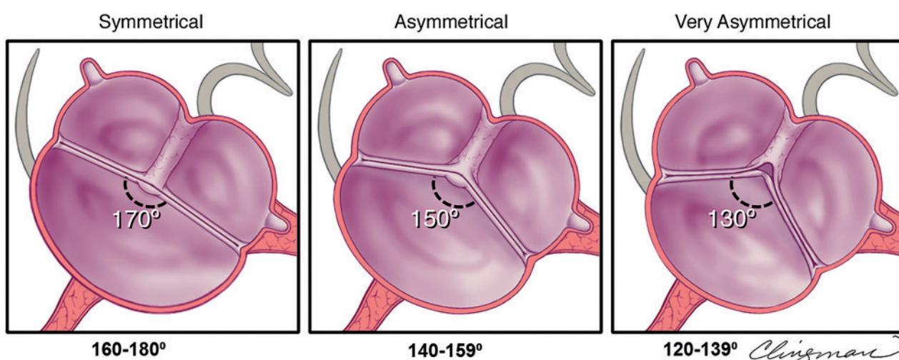 【FLOWCHART/Diagnostic algorithm for Bicuspid Aortic Valve】Bicuspid Aortic Valve Echo, CCT, CMR