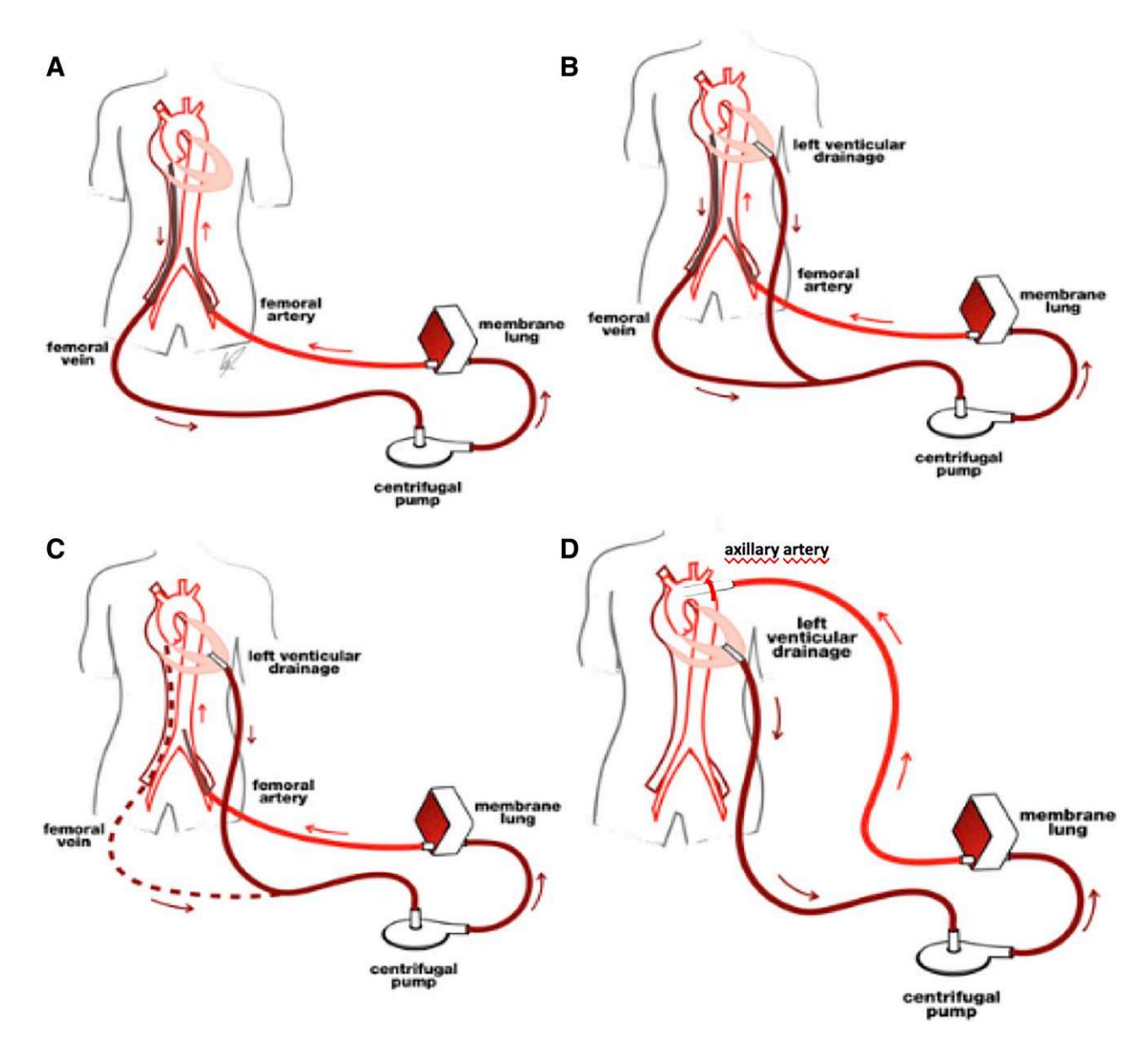 【ELSO Interim Guidelines for Venoarterial Extracorporeal Membrane Oxygenation in Adult Cardiac Patients】Medical illustration of ECMO configurations