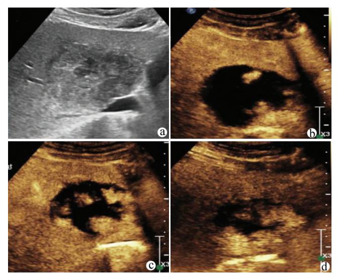 image_category: MEDICAL_IMAGING/超声造影 (CEUS) | body...