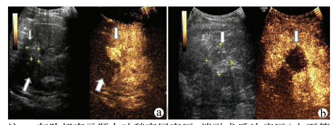 image_category: MEDICAL_IMAGING/超声造影 (CEUS) | body...