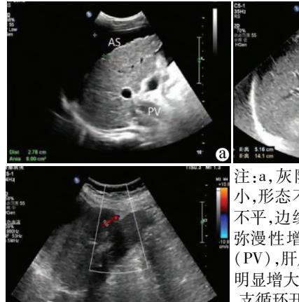 【肝硬化伴腹水及门静脉高压超声影像】