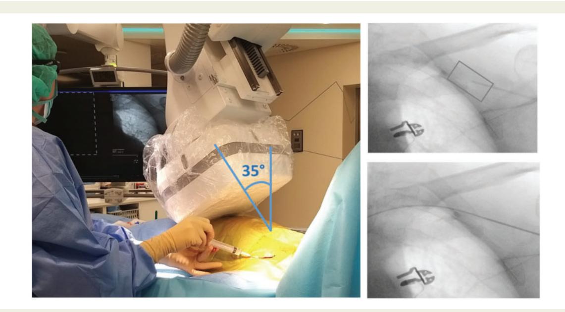 【Fluoroscopy-guided subclavian vein puncture】透视引导下锁骨下静脉穿刺