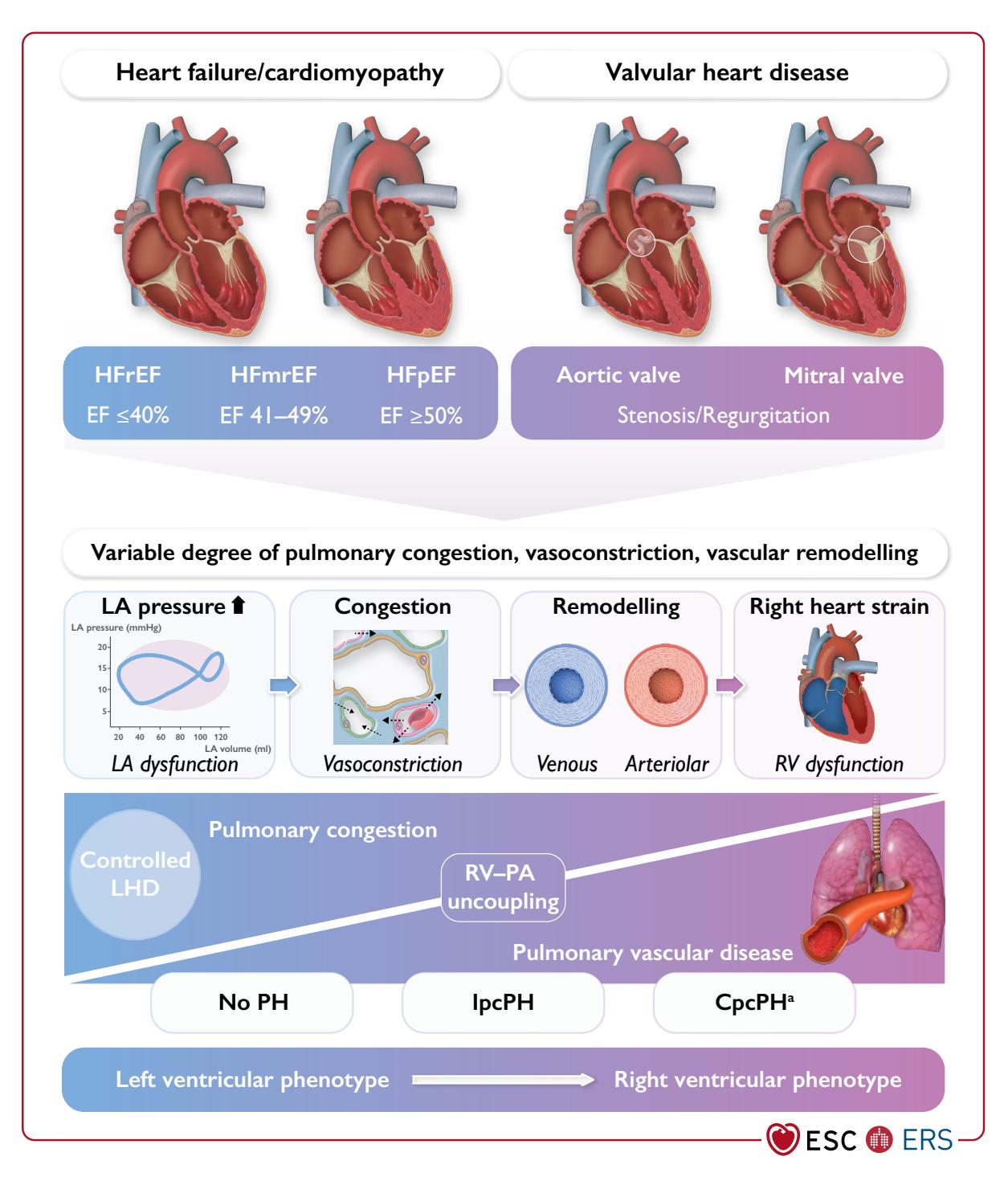 【2022 ESC/ERS Guidelines for the diagnosis and treatment of pulmonary hypertension】Pathophysiology Diagram