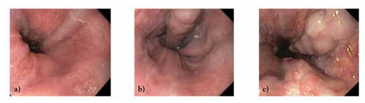 【CROATIAN GUIDELINES FOR THE DIAGNOSIS AND TREATMENT OF PORTAL HYPERTENSION】Upper Gastrointestinal Endoscopy