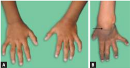 【Textbook of Pediatrics】Systemic Lupus Erythematosus: Butterfly rash