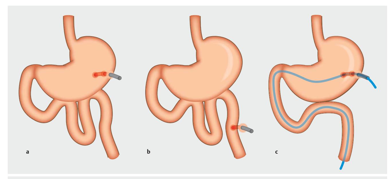 Percutaneous Enteral Access Methods: PEG, PEJ, and PEG-J