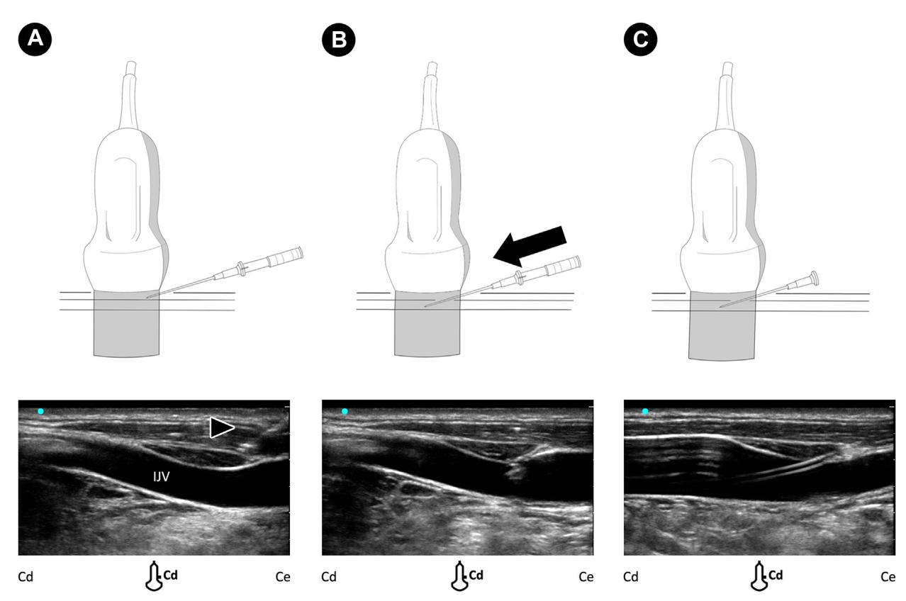 【Guidelines for Performing Ultrasound-Guided Vascular Cannulation: Recommendations of the American Society of Echocardiography】Ultrasound-guided identification of a guidewire within a vessel lumen using short-axis (SAX) and long-axis (LAX) views.