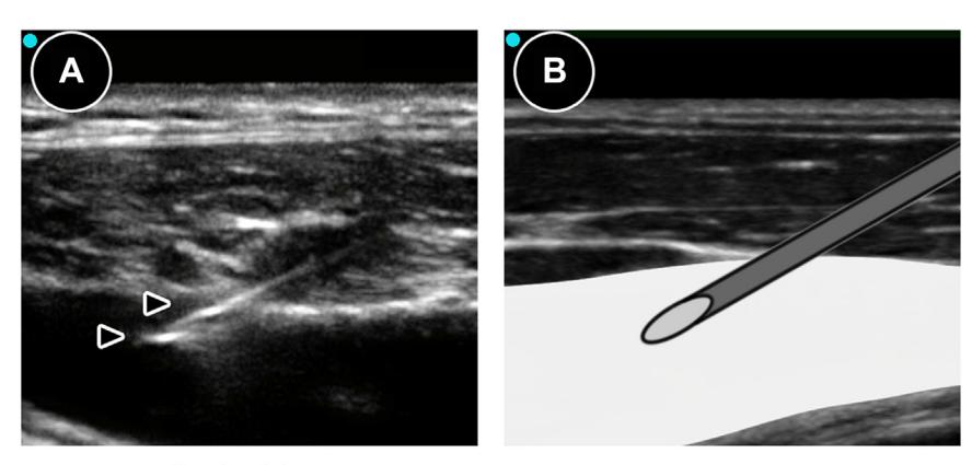 【Vascular Access Principles and Practice】Ultrasound-Guided In-Plane Needle Insertion
