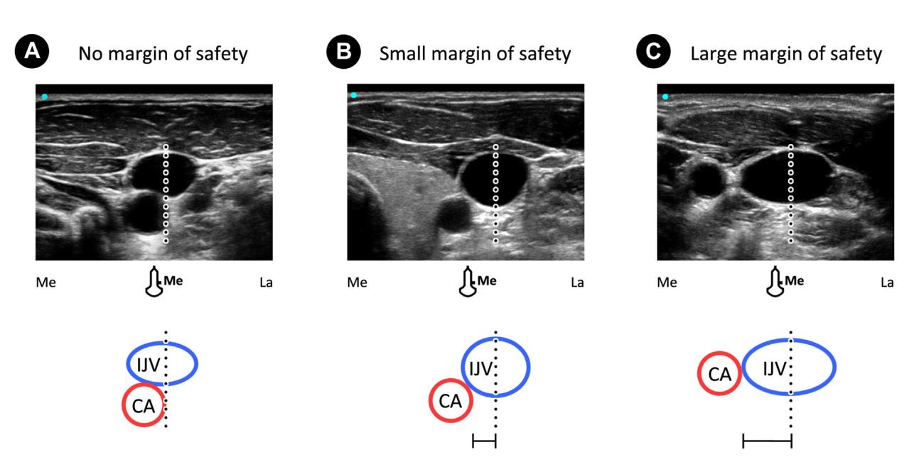 【Vascular Access Principles and Practice】Anatomical Variations of Internal Jugular Vein Relative to Carotid Artery