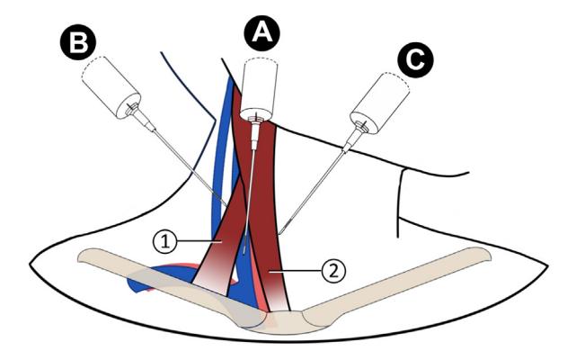 【Vascular Access Principles and Practice】Anterior, Central, and Posterior Approaches for Internal Jugular Vein Cannulation