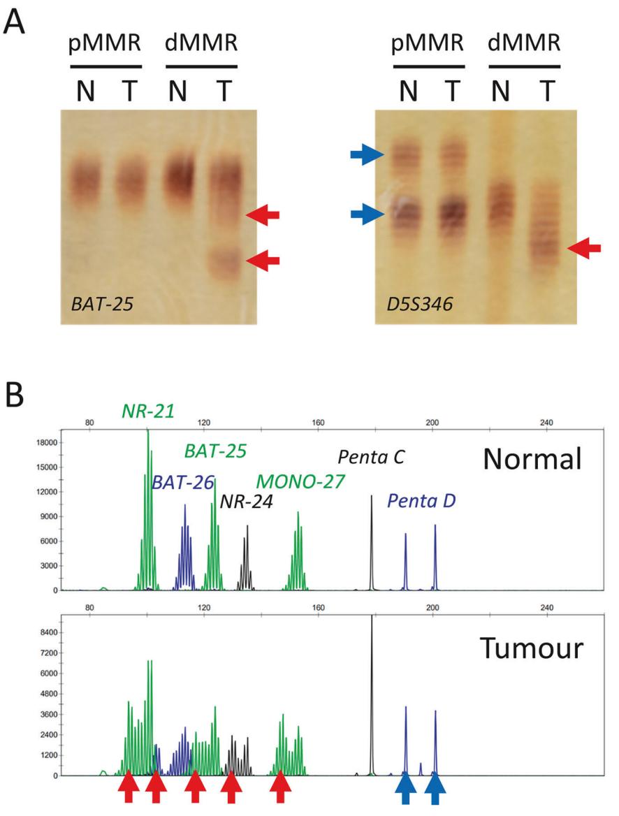 image_category: DIAGRAM/Microsatellite Instability (MSI) Analysis | body_region: NA | specialty: Molecular Pathology | summary: Comparison of MSI status in normal and tumor tissues using gel and capillary electrophoresis, demonstrating characteristic allelic shifts in dMMR/MSI-H samples. | detail: The image illustrates the molecular diagnosis of microsatellite instability (MSI) through two modalities. Panel A shows silver-stained polyacrylamide gel electrophoresis for markers BAT-25 and D5S346. In pMMR (proficient mismatch repair) cases, the normal (N) and tumor (T) lanes show identical banding patterns. In dMMR (deficient mismatch repair) cases, the tumor lane displays novel, faster-migrating bands (red arrows), indicating deletions within the microsatellite repeats. Blue arrows in the D5S346 pMMR gel denote the expected wild-type alleles. Panel B displays capillary electrophoresis electropherograms for a multiplex PCR assay. The x-axis represents DNA fragment size (80–240 bp), and the y-axis represents fluorescence intensity (up to 18,000 RFU for normal, 8,400 RFU for tumor). The 'Normal' profile shows stable peaks for markers NR-21, BAT-25, BAT-26, NR-24, and MONO-27. In the 'Tumour' profile, these mononucleotide markers exhibit significant 'stutter' patterns and leftward allelic shifts (red arrows), diagnostic of MSI-High status. The pentanucleotide markers Penta C (~180 bp) and Penta D (~200 bp) show altered peak ratios (blue arrows), suggesting chromosomal instability or loss of heterozygosity. These molecular signatures are essential for identifying patients with Lynch syndrome and those likely to benefit from immunotherapy. | entities: diseases=Microsatellite instability, MSI-High, Deficient mismatch repair, dMMR, Proficient mismatch repair, pMMR, Lynch syndrome; anatomical_structures=Tumor tissue, Normal tissue; interventions=Gel electrophoresis, Capillary electrophoresis, PCR, MSI testing; biomarkers=BAT-25, D5S346, NR-21, BAT-26, NR-24, MONO-27, Penta C, Penta D; findings=BAT-25 band shift in dMMR tumor, D5S346 band shift in dMMR tumor, NR-21 allelic shift at ~100bp, BAT-25/BAT-26 shifts at ~120bp, NR-24 shift at ~135bp, MONO-27 shift at ~155bp, Penta C/D peak height alterations at 180-200bp, X-axis: fragment size (bp), Y-axis: fluorescence intensity (RFU)