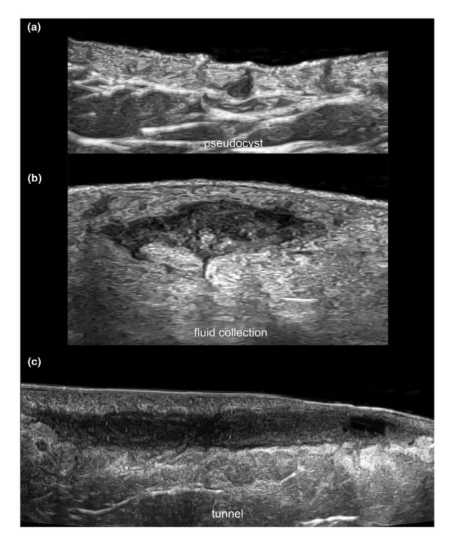 【International consensus statement on the use of ultrasound in hidradenitis suppurativa】Ultrasound