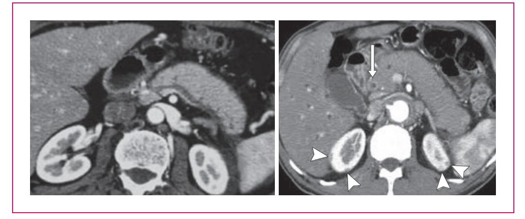 【European Guideline on IgG4-related Digestive Disease - UEG and SGF Evidence-Based Recommendations】CT Scan