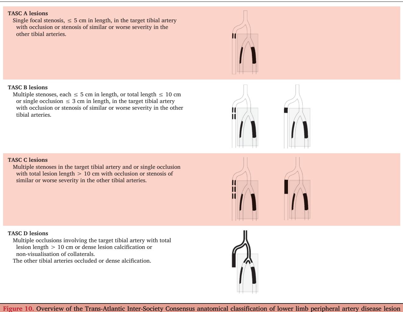 【European Society for Vascular Surgery (ESVS) 2024 Clinical Practice Guidelines on the Management of Asymptomatic Lower Limb Peripheral Arterial Disease and Intermittent Claudication】Anatomical classification diagram