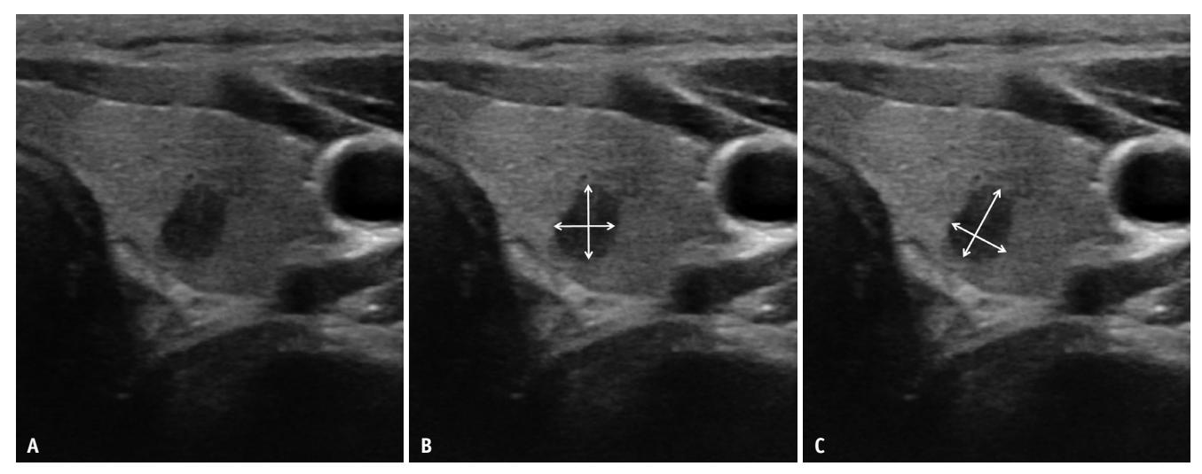 【Standardized Ultrasound Evaluation for Active Surveillance of Low-Risk Thyroid Microcarcinoma in Adults: 2024 Korean Society of Thyroid Radiology Consensus Statement】Ultrasound