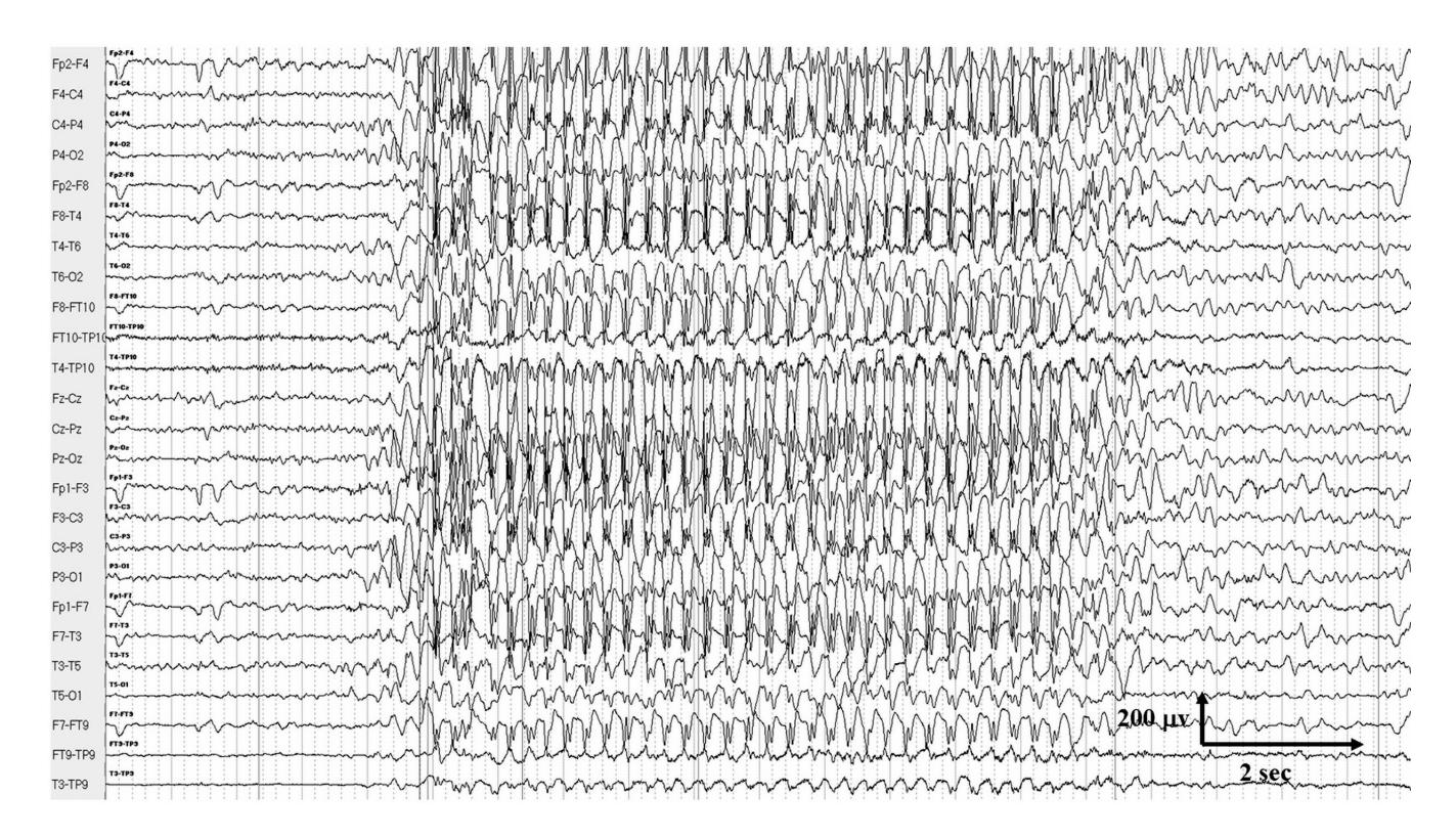 【CLINICAL_PHOTO/Electroencephalogram (EEG)】Generalized 3 Hz spike-and-wave discharges characteristic of an absence seizure.
