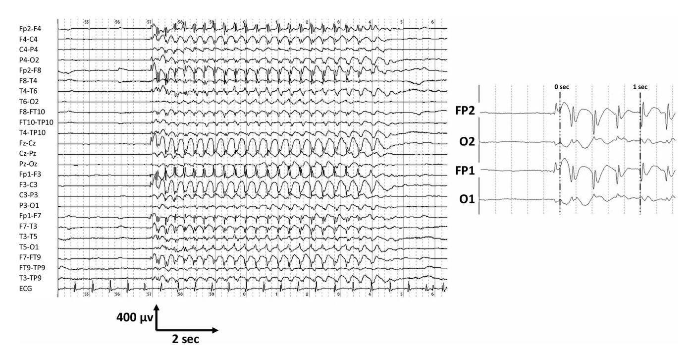 【CLINICAL_PHOTO/Electroencephalogram (EEG)】The EEG recording demonstrates a sudden onset of generalized, rhythmic 3 Hz spike-and-wave discharges, characteristic of an absence seizure.