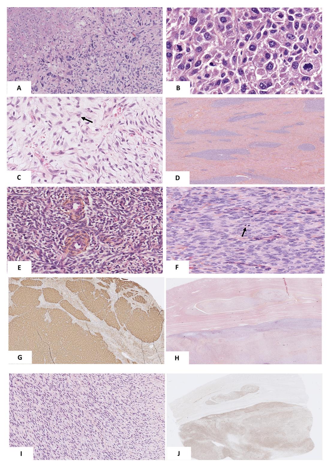 Diagnostic algorithm for uterine smooth muscle tumors