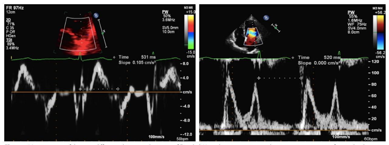【The assessment of left ventricular diastolic function: guidance and recommendations from the British Society of Echocardiography】Echocardiography