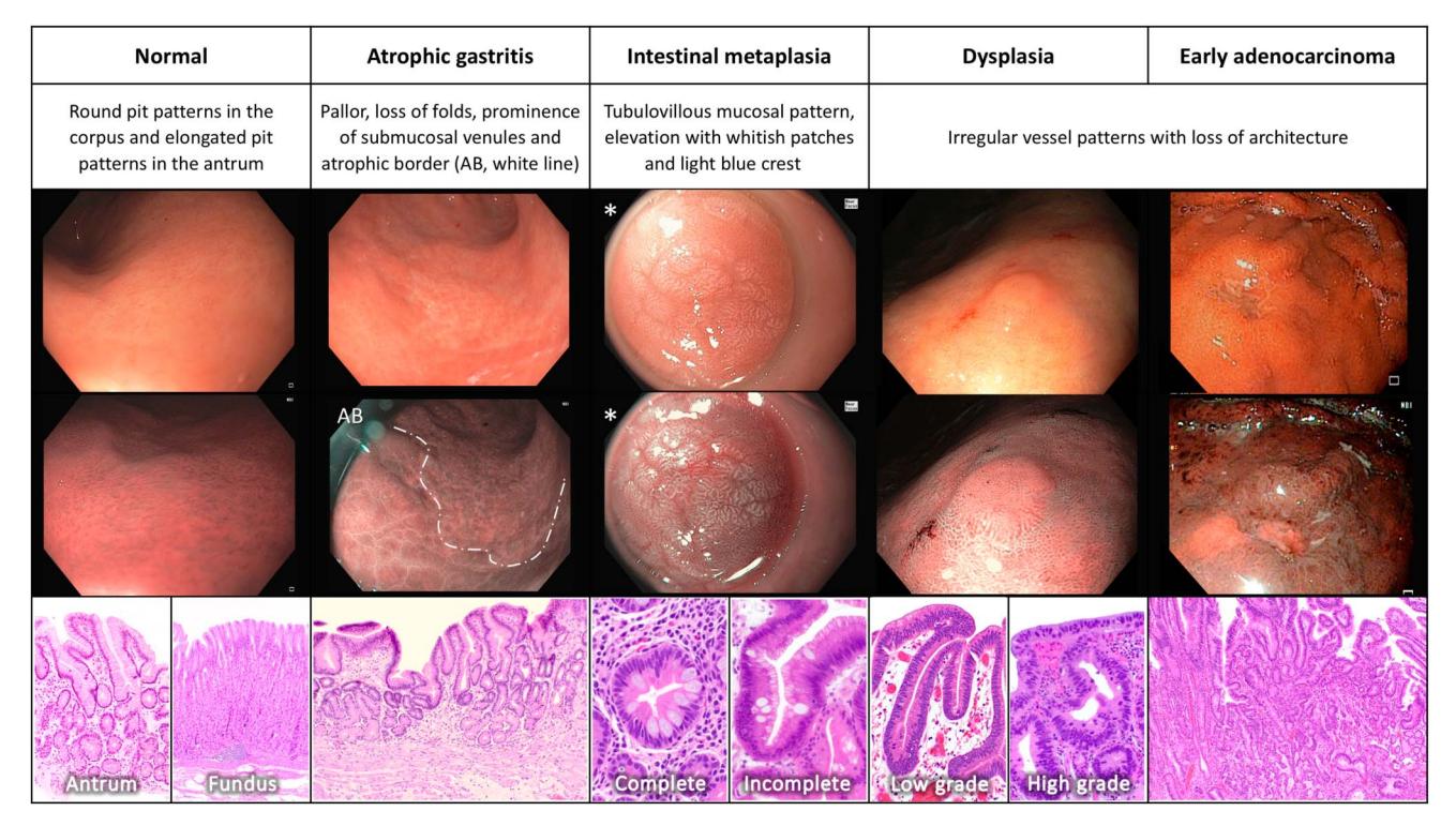 【Gastroscopic and histopathological progression chart】Gastric mucosal progression from normal to early adenocarcinoma