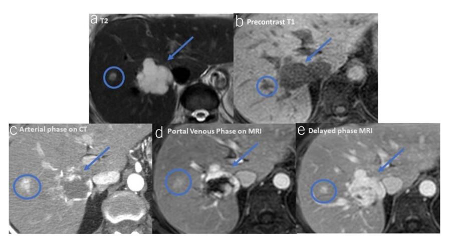 【Rapid Review of Radiology】Hepatic Hemangioma MRI and CT