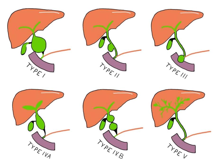 【ACG Clinical Guideline: Focal Liver Lesions】Todani classification of choledochal cysts