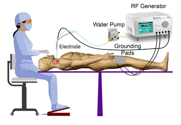 image_category: DIAGRAM/Radiofrequency ablation procedure diagram
