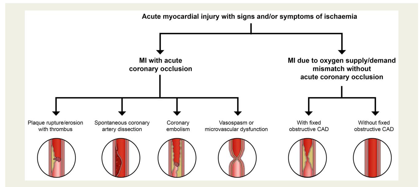 【National Heart Foundation of Australia & Cardiac Society of Australia and New Zealand: Comprehensive Australian Clinical Guideline for Diagnosing and Managing Acute Coronary Syndromes 2025】Myocardial Infarction Classification Algorithm