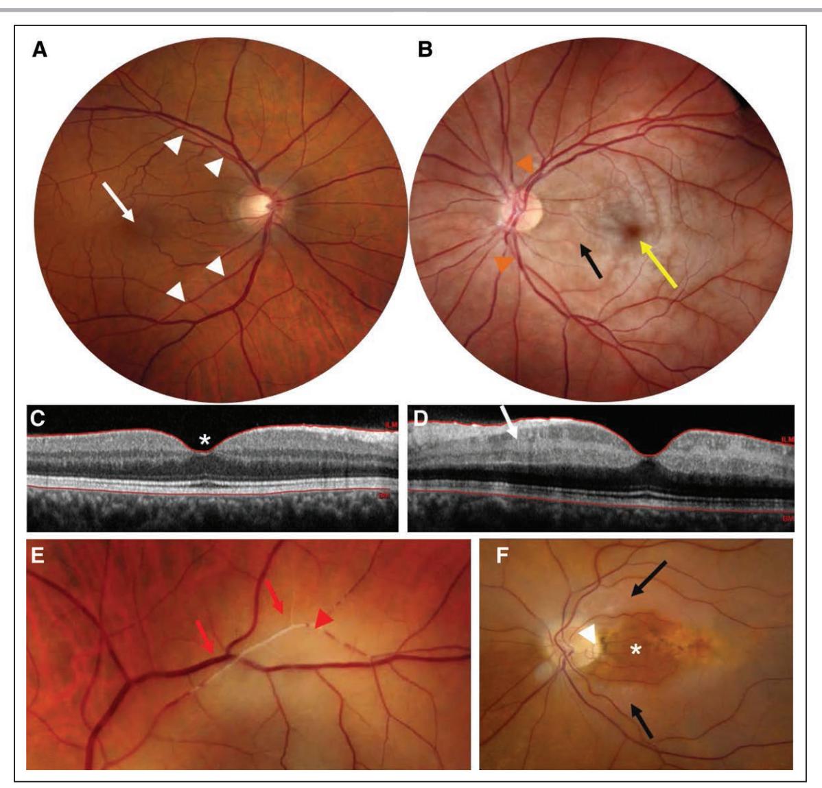 【Management of Central Retinal Artery Occlusion: A Scientific Statement From the American Heart Association】Fundus photography and Optical Coherence Tomography (OCT)
