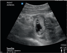 【Managing Obstetrics Complications】Diagnostic approach to the pregnant patient in the first trimester with symptoms of abdominal pain and/or vaginal bleeding