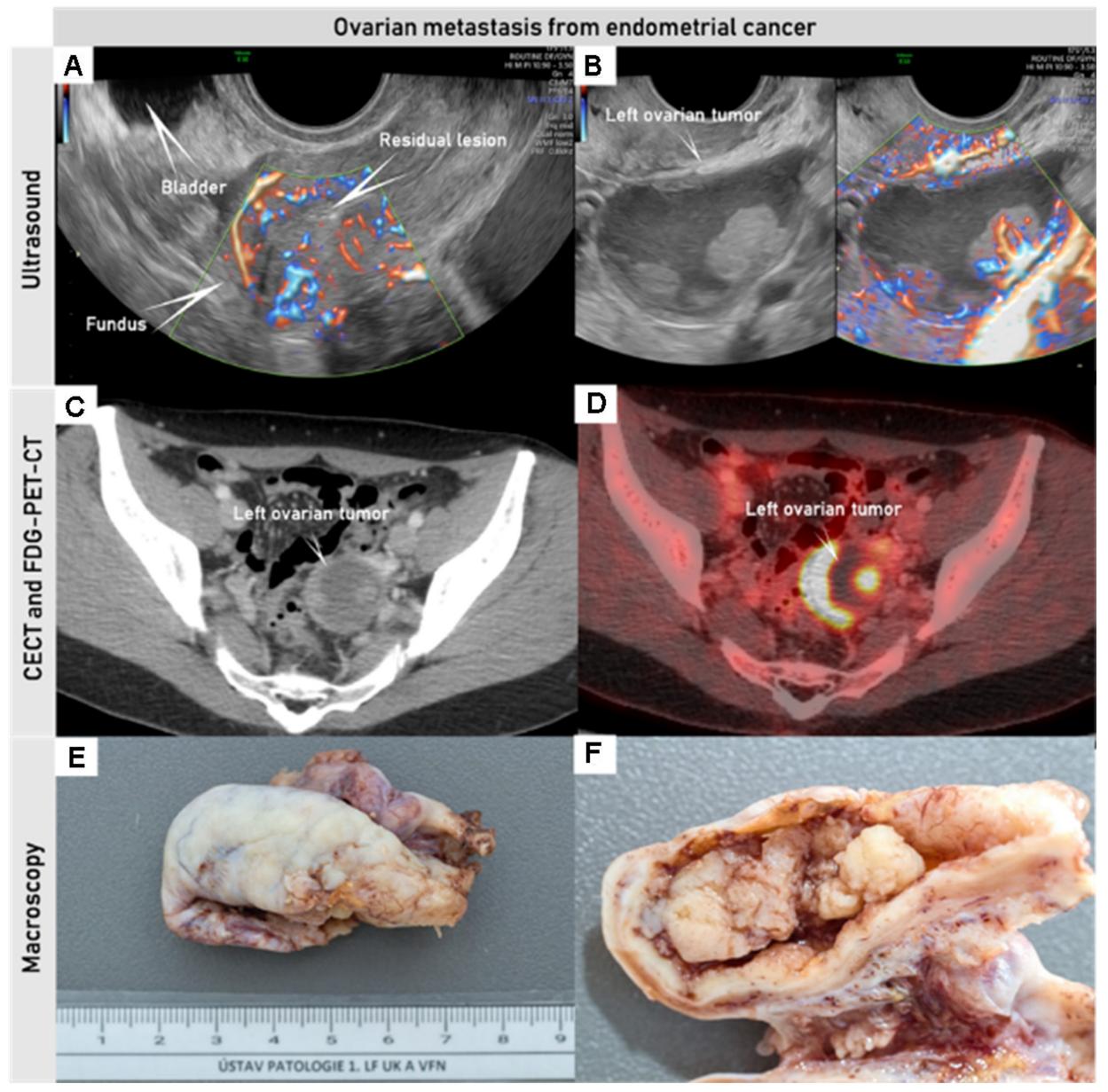 【Staging by imaging in gynecologic cancer and the role of ultrasound: an update of European joint consensus statements】Ultrasound, CECT, FDG-PET-CT, Macroscopy